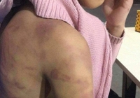 Nghi án bé gái 12 tuổi bị mẹ ruột và người tình bạo hành dã man