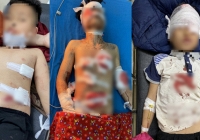 Tuyên Quang: 4 học sinh bị thương nặng khi dùng máy xay sinh tố để trộn hóa chất