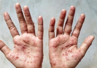 Hướng dẫn chẩn đoán, điều trị và phòng bệnh đậu mùa khỉ