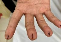 Nhập viện với vết dao lam cứa sâu vì làm theo 'thầy thuốc online'