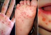 Phân bổ 6.000 chai thuốc trị tay chân miệng cho các bệnh viện