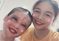 Câu chuyện về cô bé lớp 5 từng bị thiêu sống và nghị lực vươn lên nghịch cảnh sau 4 năm