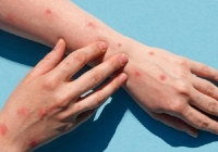 Bộ Y tế chỉ đạo không để lây nhiễm chéo bệnh đậu mùa khỉ