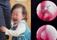 Bé gái 13 tháng tuổi ở Bình Thuận khóc dữ dội sau khi tắm suối, gia đình tá hỏa khi thấy sinh vật lạ lấp ló trong lỗ mũi 