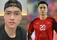 Bùi Hoàng Việt Anh than 'mồm méo' khi cắt chỉ 24 mũi khâu vết rách môi, độ điển trai của nam thần tuyển Việt Nam liệu có sụt giảm?
