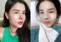 Kỳ Hân - vợ Mạc Hồng Quân khoe mũi sau phẫu thuật thẩm mỹ nhưng dân tình lại khen mũi cũ đẹp hơn