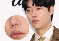 Gỉ mũi gây khó chịu và 'mất thẩm mỹ', lấy sao cho đúng?