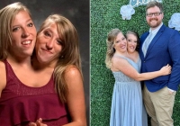 Cặp song sinh dính liền nổi tiếng nhất thế giới: Dùng chung một cơ thể suốt 34 năm, cuộc sống hiện tại gây kinh ngạc