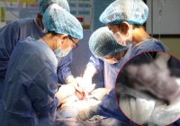 Người phụ nữ ở Bạc Liêu bỗng đau bụng dữ dội, phẫu thuật lấy ra được một thứ nặng đến 900 gram