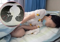 Cô gái trị mồ hôi tay lại vô tình phát hiện ung thư phổi, bác sĩ nhắc nhở những thói quen sinh hoạt của người trẻ