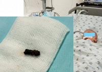 Bé trai 8 tháng tuổi chơi với trái xoài rồi đột ngột ho sặc sụa, nhập viện trong tím tái: 2 Bệnh viện phối hợp lấy dị vật