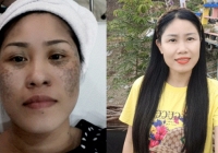 Hành trình lột xác từ 'mặt đen tối sầm' thành 'mặt hoa da phấn' của người phụ nữ 40 tuổi sau 3 năm từ Điện Biên về Hà Nội