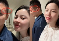 Quang Hải lộ dấu vết khác lạ trên mặt, nghi bị 'vợ đấm', Chu Thanh Huyền lên tiếng giải thích