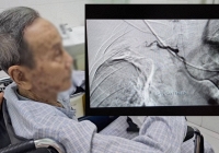 Cụ ông 87 tuổi bị 'ho ra máu sét đánh', tỷ lệ tử vong gần như 100% và kỳ tích xảy ra