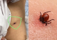 Đi hai bệnh viện, bệnh nhân mới tìm ra nguyên nhân gây suy đa tạng từ vết loét nhỏ trên da