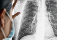 Cảnh giác với các nốt nhỏ ở phổi: Nơi những tế bào ung thư phát triển âm thầm