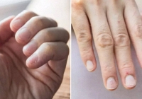 Bàn tay lạnh có thể là dấu hiệu cảnh báo của tình trạng sức khỏe được coi là 'kẻ giết người thầm lặng'