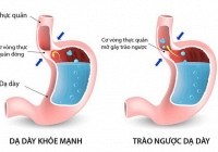 Đừng để GERD âm thầm tấn công sức khỏe bạn