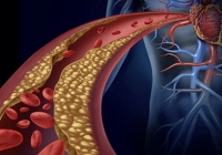 Công nghệ nano mới giúp phát hiện và loại bỏ mảng bám gây bệnh tim mạch