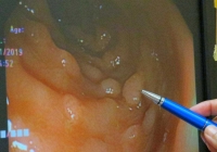 Polyp ở 3 vùng dễ dẫn đến ung thư, 5 thói quen tốt cần làm để tránh