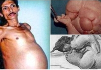 Người đàn ông mang trong mình 'thai chết lưu' suốt 36 năm, bào thai nặng 4kg, có cả tóc và tay chân 