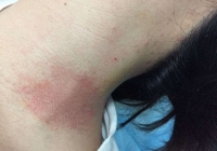 Người phụ nữ bỏng nặng sau khi tắm, bác sĩ nhắc đừng có thói quen tắm rửa này