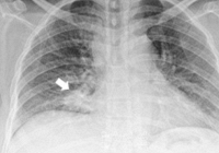 Người phụ nữ phát hiện ung thư phổi ẩn giấu nhờ 1 dấu hiệu ở mắt 