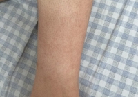 Người phụ nữ sốt cao, rải rác ban xuất huyết như đinh ghim 2 cổ chân, bác sĩ cảnh báo căn bệnh đang vào mùa