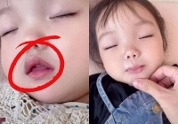 Thấy con gái 8 tuổi ngủ mở miệng, mẹ dùng băng keo dán khiến bé suýt ngạt thở, bác sĩ chỉ ra sai lầm