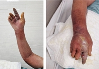 Bàn tay người đàn ông xuất hiện nhiều mụn mủ, rỉ dịch vàng sau khi bị chó cắn