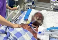 Người đàn ông bị tiêu chảy nặng, bầm tìm khắp người, suýt chết vì sai lầm khi sơ chế thịt lợn nhiều người mắc