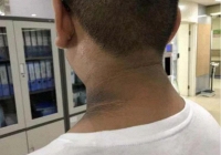 “6 đen, 2 hôi” trên cơ thể là dấu hiệu lượng đường trong máu tăng mất kiểm soát