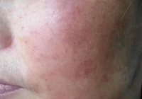 Người phụ nữ được chẩn đoán mắc ung thư da, thói quen tắm rửa của nhiều người là nguyên nhân