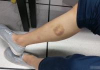 Xuất hiện vết bầm tím ở bắp chân, cậu bé 13 tuổi mắc căn bệnh 'đáng sợ hơn cả HIV/AIDS'