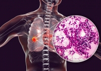 Tình trạng viêm có thể là “mồi lửa” khởi phát ung thư phổi ở giai đoạn sớm