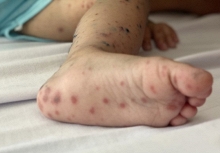Virus Enterovirus 71 gây bệnh tay chân miệng nặng xuất hiện trở lại​