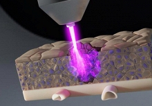 Tia plasma lạnh, 'vũ khí mới' trong điều trị ung thư: diệt khối u ẩn, giảm nguy cơ tái phát