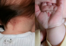 Em bé có bớt đỏ trên người: Dấu hiệu cho thấy con sinh ra với một “vết son” đặc biệt