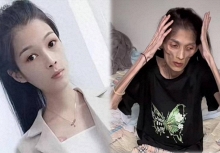 Bệnh gì khiến người phụ nữ 27 tuổi cao 1,6m nhưng chỉ nặng 17,5kg bị 'teo dạ dày' và qua đời: BS khuyến cáo loại vi khuẩn có liên quan