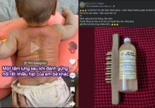 Hội mẹ bỉm hoang mang với trường phái 'đánh gừng xuyên khung': Đánh gừng trị bách bệnh từ ốm sốt đến tăng chiều cao?