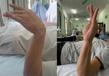 Ngủ gật 30 phút trong giờ làm, người đàn ông 37 tuổi bỗng liệt dây thần kinh, không nhấc nổi cổ tay