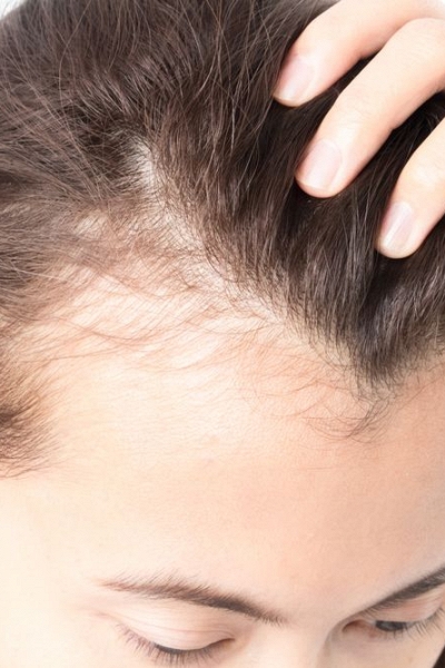 Phát hiện loại đường tự nhiên giúp kích thích mọc tóc mà không gây tác dụng phụ