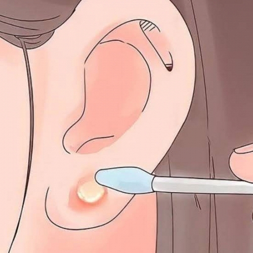 Cách chữa bấm lỗ tai bị mưng mủ tại nhà hiệu quả, an toàn