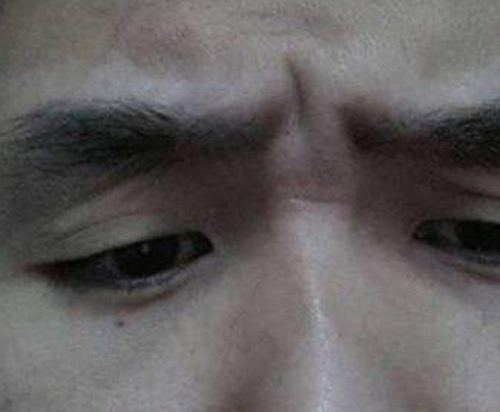 Các bác sĩ cảnh báo: Không cần chờ đến khi tức ngực, thấy 3 thứ này ở đầu và mặt tức là tim mạch đang 'báo động'