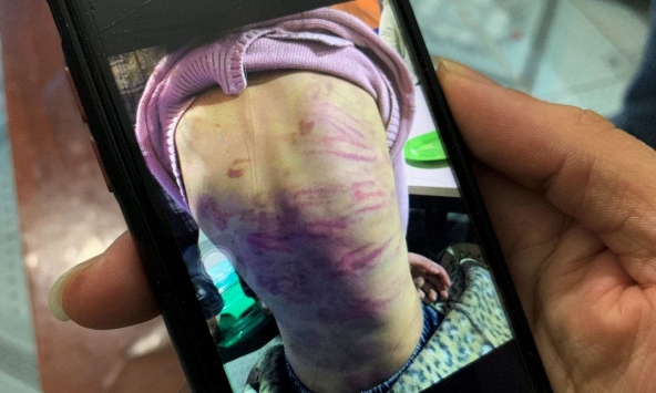 Bé gái 12 tuổi bị mẹ bạo hành, bạn trai của mẹ xâm hại tình dục