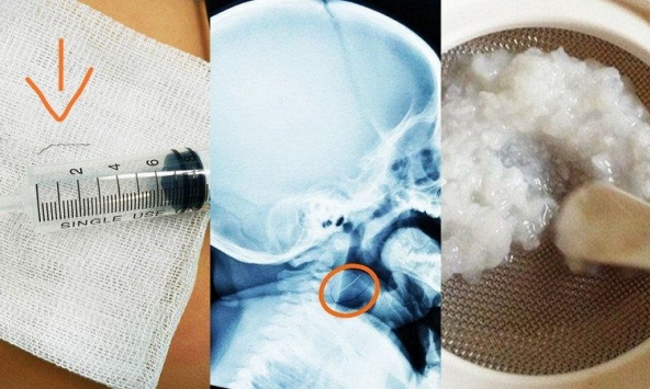 Bé trai cấp cứu do nuốt phải sợi thép rơi từ lưới ray thức ăn