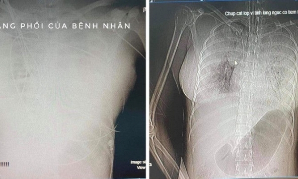 Một phụ nữ tử vong sau khi tiêm filler nâng ngực