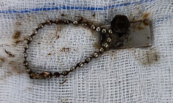 Bé trai 6 tuổi bị thủng ruột do nuốt miếng nam châm