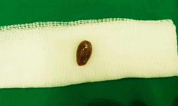 Bé 18 tháng cấp cứu do ăn hạt dưa