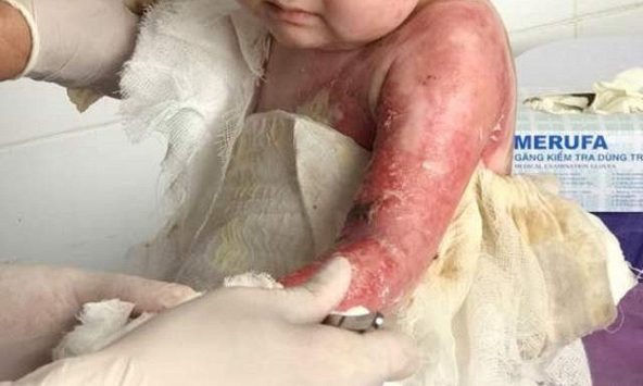 Bé 9 tháng tuổi tử vong do được 'thầy lang' đắp lá chữa vết bỏng